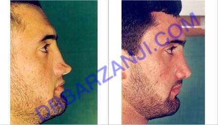 عکس ترمیم بینی