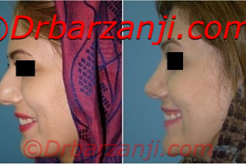 عکس قبل و بعد جراحی پلاستیک بینی شش ماه بعد