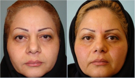 هزینه عمل بلفاروپلاستی