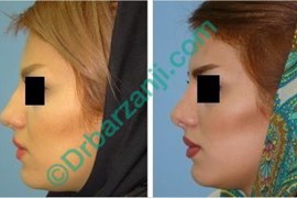 جراحی پلاستیک بینی شش ماه بعد از عمل