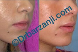 تزریق ژل جوویدرم  ( ژوویدرم ) به لب