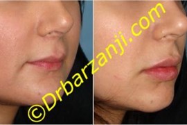 تزریق ژل در لب