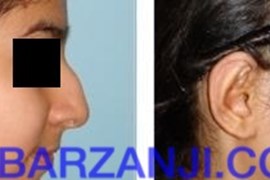 عمل جراحی پلاستیک لاله گوش