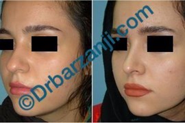 جراحی پلاستیک بینی نه ماه بعد از عمل