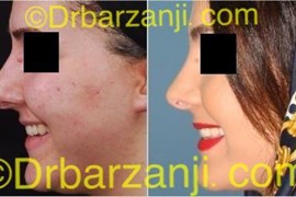 عمل جراحی زیبایی بینی یک سال بعد