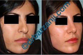 جراحی بینی یک ماه بعد از عمل