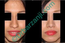 یک سال بعد از جراحی پلاستیک بینی