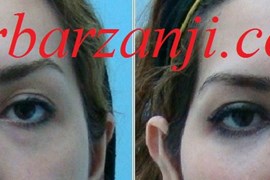 تزریق چربی در فرورفتگی زیر چشم ها