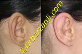 جراحی برجستگی لاله گوش