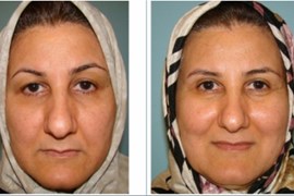 عمل جراحی پلک (بلفاروپلاستی) فوقانی