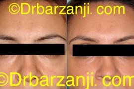 تزریق چربی زیر چشم ها