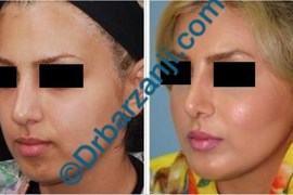 پروتز چانه و گونه سه هفته بعد از عمل