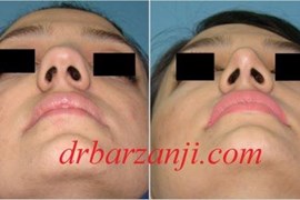 جراحی بینی کج