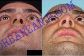 عمل جراحی پلاستیک بینی ٢ سال بعد