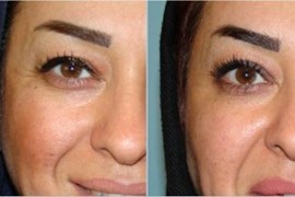 بهبودی خطوط کنار چشم با تزریق دیسپورت