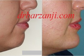 پروتز چانه