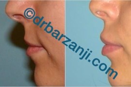 تزریق ژل لب (جوویدرم )
