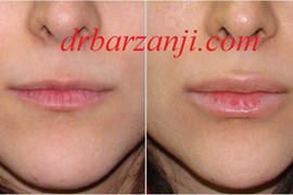 تزریق فیلر ژوویدرم در لب