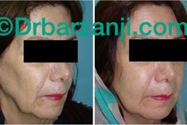 تزریق چربی صورت