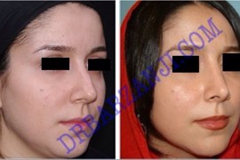 جراحی بینی ، ۶ ماه بعد از عمل