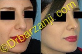 جراحی بینی سه ماه بعد از عمل