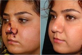 پارگی و شکستگی بینی 7