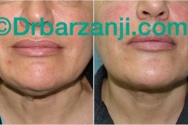 تزریق بوتاکس در گردن