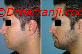 پروتز چانه یک هفته بعد از عمل