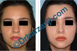 جراحی پلاستیک بینی نه ماه بعد از عمل
