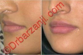 تزریق ژل جوویدرم ( ژوویدرم ) در لب ده روز بعد
