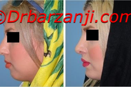 جراحی بینی و پروتز چانه و گونه شش ماه بعد