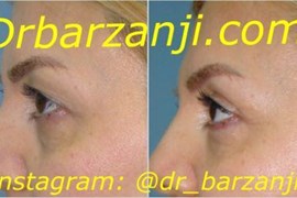 جراحی زیبایی پلک بالا ( بلفاروپلاستی )