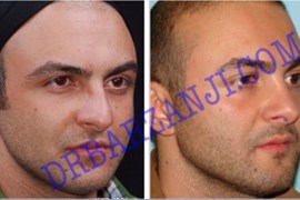عمل جراحی پلاستیک بینی ٢ سال بعد