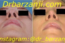 جراحی ترمیمی بینی دو هفته بعد از عمل