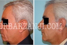 فیس لیفت و پروتز چانه