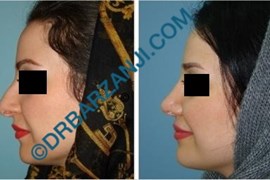 جراحی بینی یک سال بعد از عمل