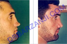 ترمیم بینی