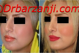 جراحی بینی و پروتز چانه و گونه شش ماه بعد