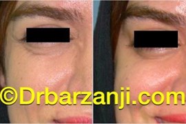 کاهش خطوط خنده کنار چشم با تزریق بوتاکس ( دیسپورت )