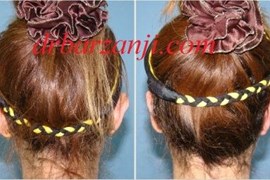 جراحی زیباییی لاله گوش ( اتوپلاستی )