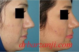 جراحی بینی کج