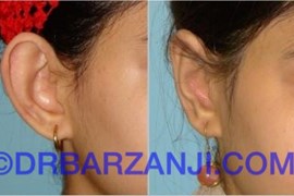عمل جراحی پلاستیک لاله گوش