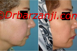 پروتز چانه با بهبود نسبی افتادگی پوست کنار چانه