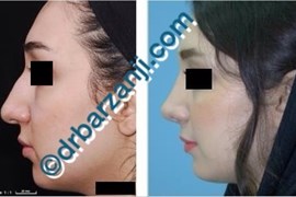 جراحی پلاستیک بینی یک سال بعد از عمل