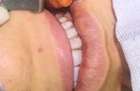 برداشت چربی دهانی (Buccal fat reduction)
