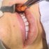 برداشت چربی دهانی (Buccal fat reduction)