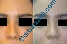 تزریق ژل رادیس در محل فرورفتگی بینی بعد از عمل