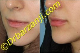 تزریق ژل لب