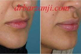 تزریق ژل جوویدرم در لب