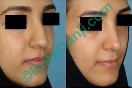 جراحی بینی ٦ ماه بعد از عمل